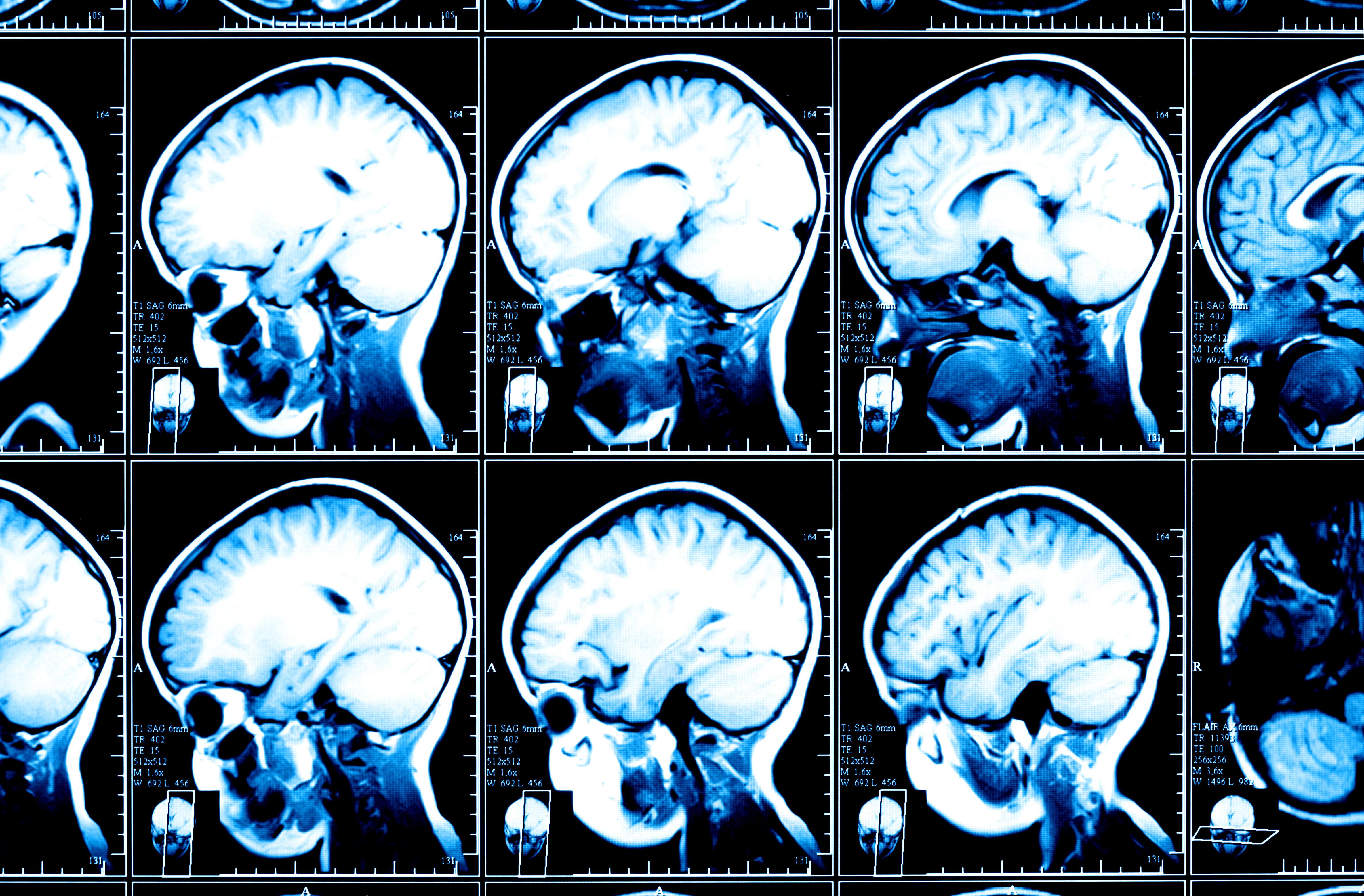 The Brain On Porn - The Brain Scan Image and the Dangers of Brain Porn - Big Think