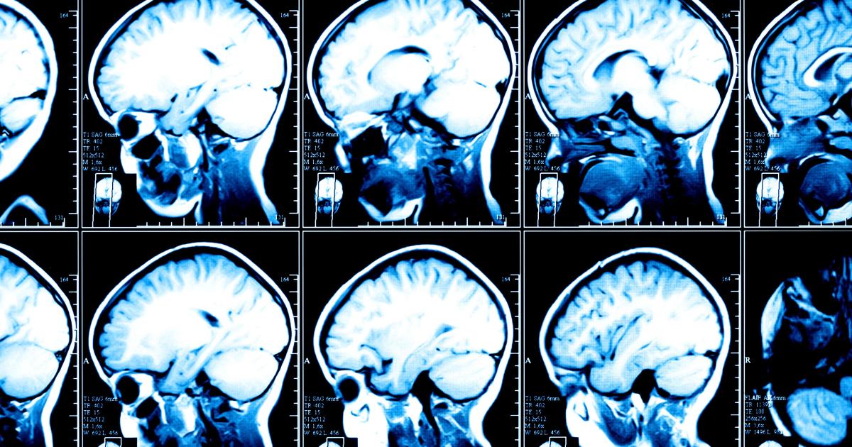 The Brain Scan Image and the Dangers of Brain Porn - Big Think