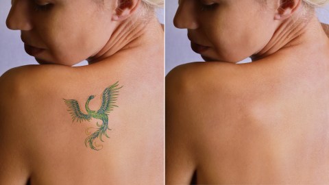 What happens to tattoos when you remove them? - Big Think