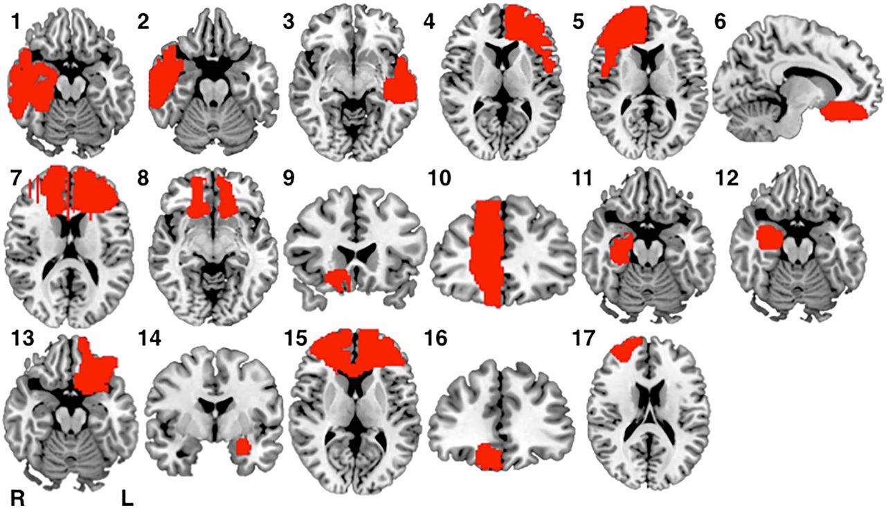 New Study Links Brain Injuries To "Acquired Sociopathy" - Big Think