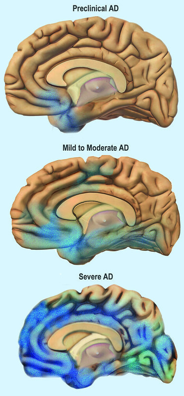 A graphic showing how Alzheimer's disease spreads through the brain as it progresses from preclinical to severe.