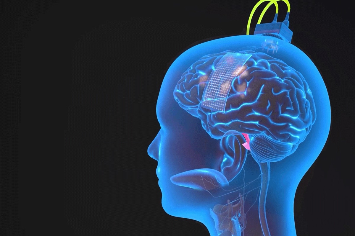 A person's brain is shown with a device attached to it.