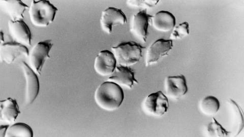 A black and white photo of a black and white photo illustrating the potential of CRISPR technology to treat sickle cell disease.