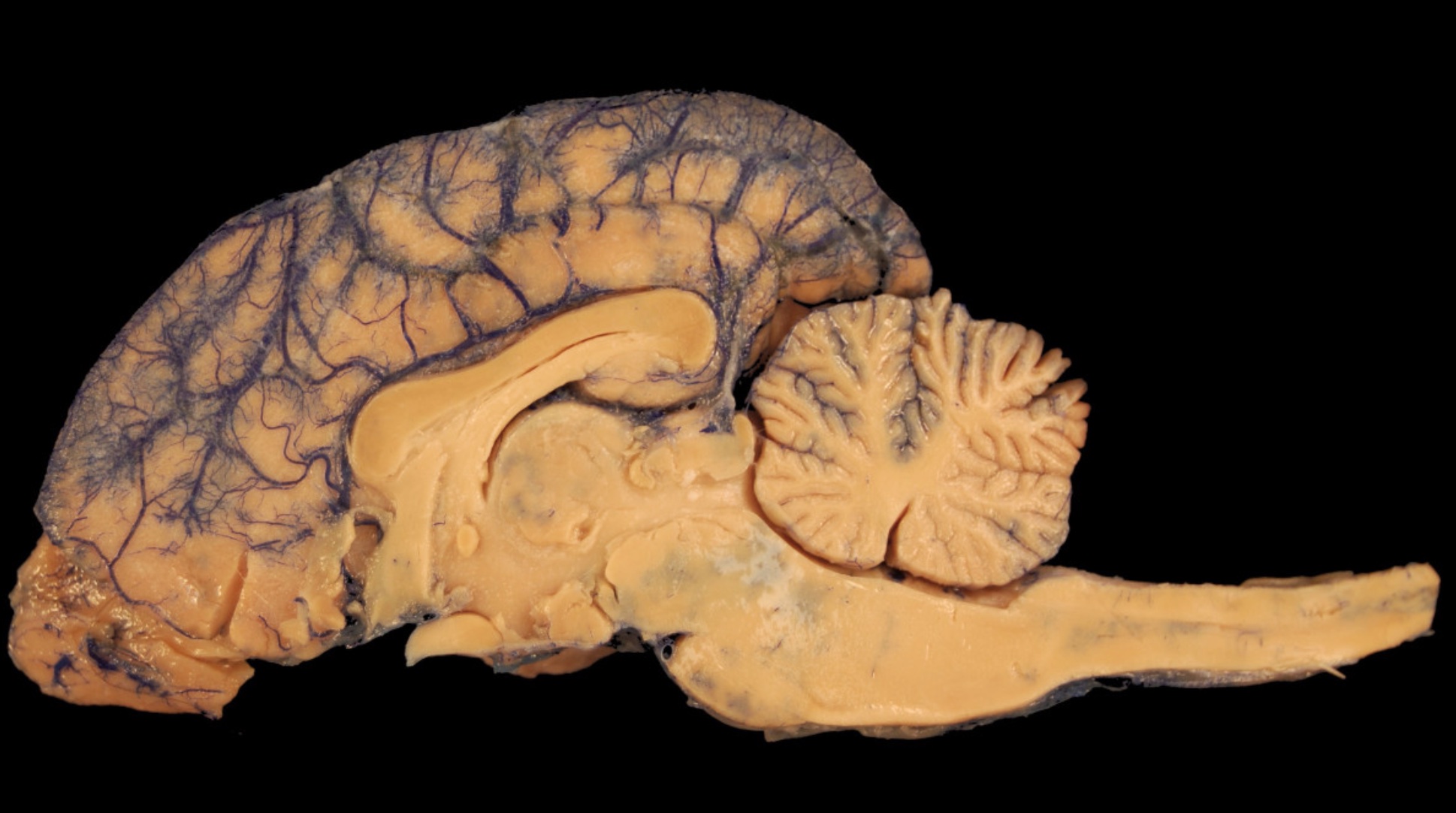 An image of a human brain on a black background.