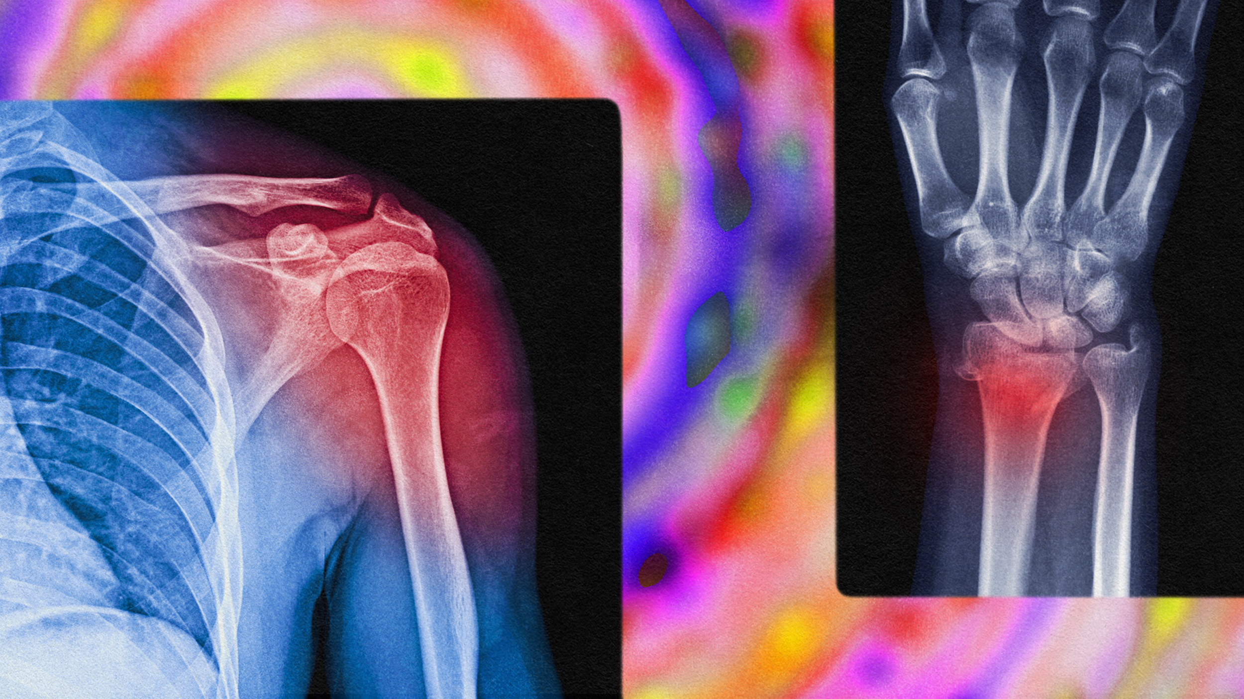X-ray images of a shoulder and a wrist with highlighted areas in red indicating injuries or inflammation, set against a colorful, abstract background.