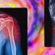X-ray images of a shoulder and a wrist with highlighted areas in red indicating injuries or inflammation, set against a colorful, abstract background.