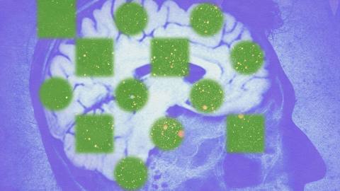 MRI scan of a brain side profile overlaid with green squares and circles, set against a purple background.