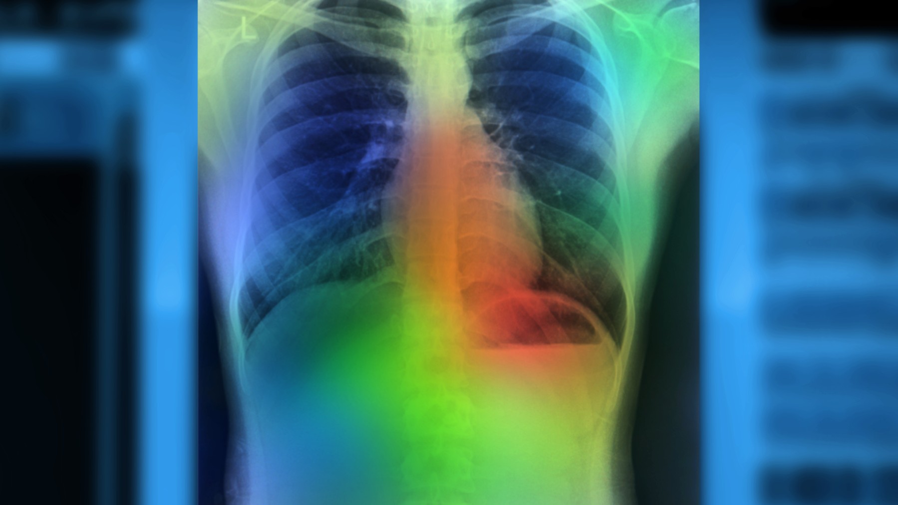 Color-enhanced chest X-ray vividly showcases the lungs, heart, and spine, offering insight into potential signs of lung cancer.