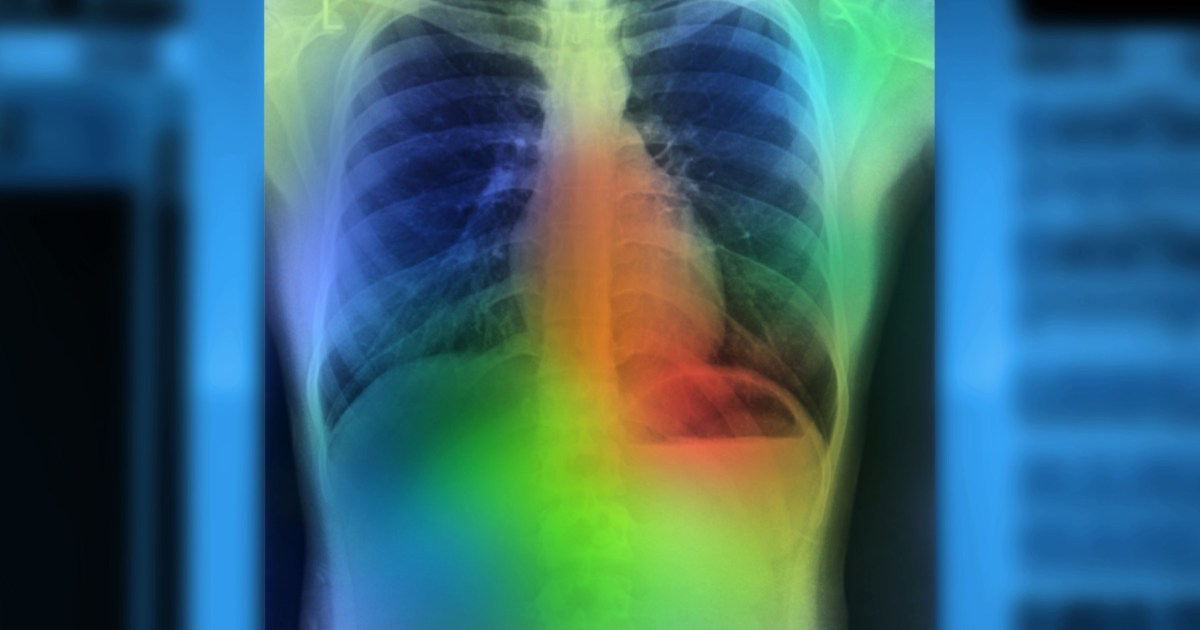 How BioNTech’s “revolutionary” lung cancer vaccine actually works